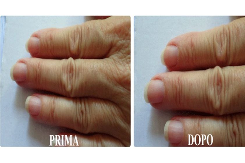 Micosi alle unghie prima e dopo - 756756