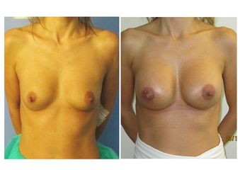Mastoplastica additiva prima e dopo