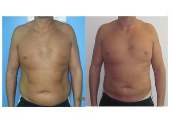 Liposuzione prima e dopo