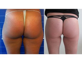 Liposcultura prima e dopo