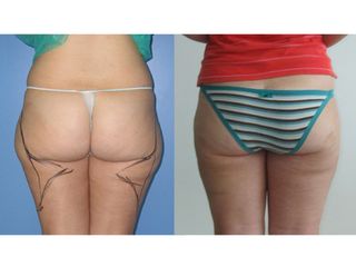 Liposcultura prima e dopo