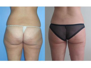 Liposuzione prima e dopo