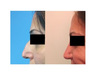Rinoplastica prima e dopo