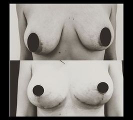 Ptosi mammaria prima e dopo