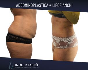 Addominoplastica - Dott. Massimiliano Calabrò