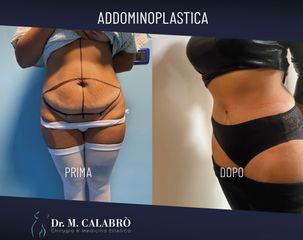 Addominoplastica - Dott. Massimiliano Calabrò