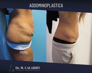 Addominoplastica - Dott. Massimiliano Calabrò