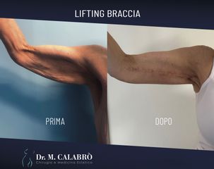 Lifting braccia - Dott. Massimiliano Calabrò