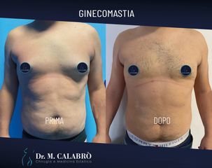 Ginecomastia - Dott. Massimiliano Calabrò
