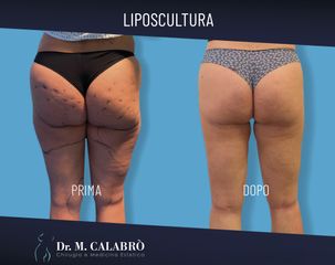 Liposuzione - Dott. Massimiliano Calabrò
