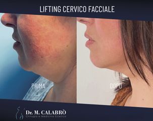 Lifting Cervico Facciale - Dott. Massimiliano Calabrò