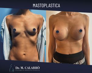 Mastoplastica additiva - Dott. Massimiliano Calabrò