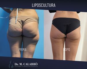 Liposuzione - Dott. Massimiliano Calabrò