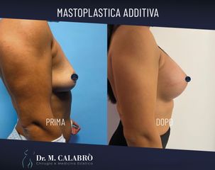 Mastoplastica additiva - Dott. Massimiliano Calabrò