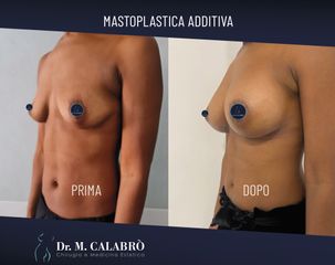 Mastoplastica additiva - Dott. Massimiliano Calabrò