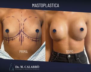 Mastoplastica additiva - Dott. Massimiliano Calabrò