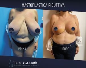 Mastoplastica riduttiva - Dott. Massimiliano Calabrò