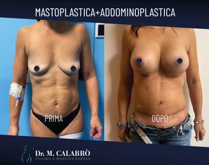 Mastoplastica+Addominoplastica - Dott. Massimiliano Calabrò
