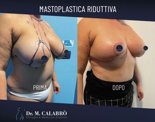 Mastoplastica riduttiva - Dott. Massimiliano Calabrò