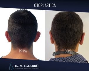 Otoplastica - Dott. Massimiliano Calabrò