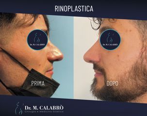 Rinoplastica - Dott. Massimiliano Calabrò