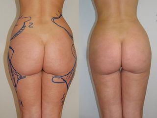 liposuzione prima dopo