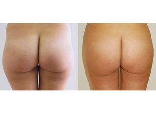 liposuzione prima dopo