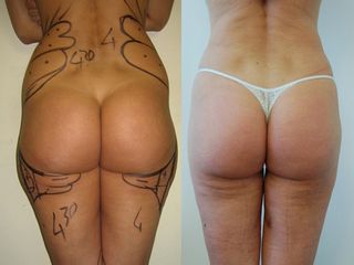 liposuzione prima dopo