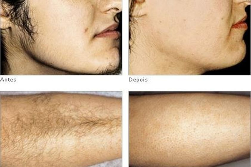 Depilazione laser prima e dopo - 748653