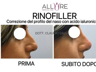 rinofiller prima e dopo