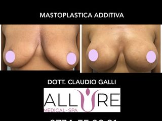mastoplastica additiva prima dopo