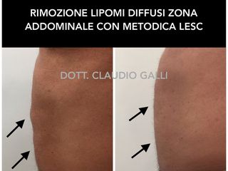 Lipomi addome prima dopo