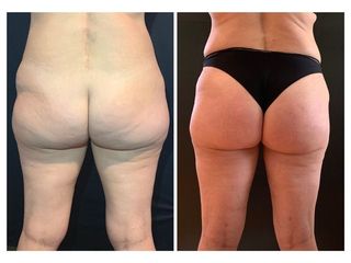 Liposuzione prima e dopo