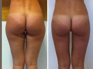 Liposuzione prima e dopo