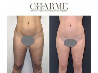 Liposuzione prima e dopo