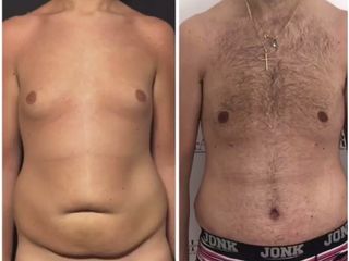 Addominoplastica prima e dopo
