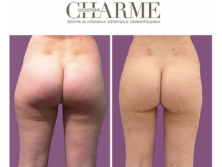 Liposuzione prima e dopo