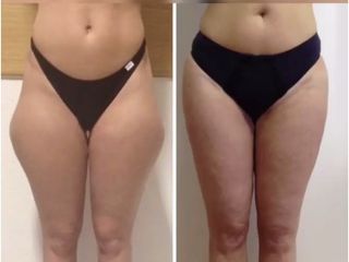 Liposuzione prima e dopo