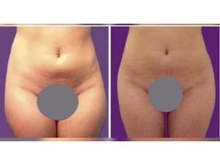Liposuzione prima e dopo