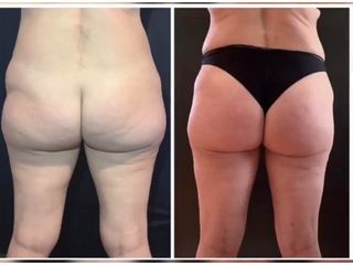 Liposuzione prima e dopo
