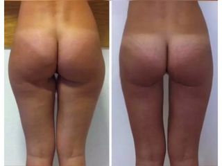 Liposuzione prima e dopo