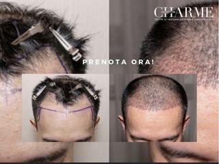 Trapianto capelli prima e dopo