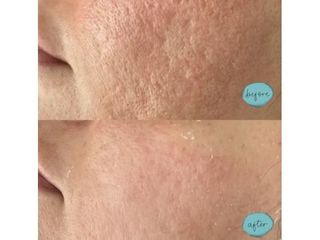 Cicatrici acne prima e dopo