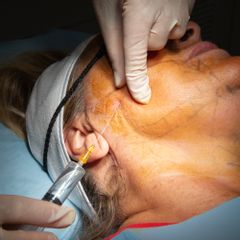 Endolift