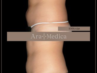 EMSculpt® prima e dopo - 851001
