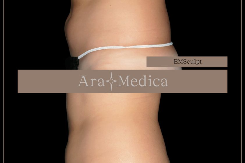 EMSculpt® prima e dopo - 851001