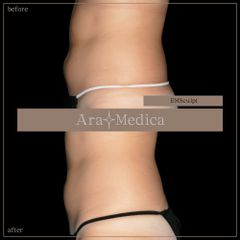 EmSculpt - Clinica AraMedica