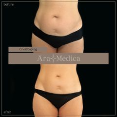 Coolshaping - Clinica AraMedica