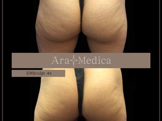 EMSculpt® prima e dopo - 857981