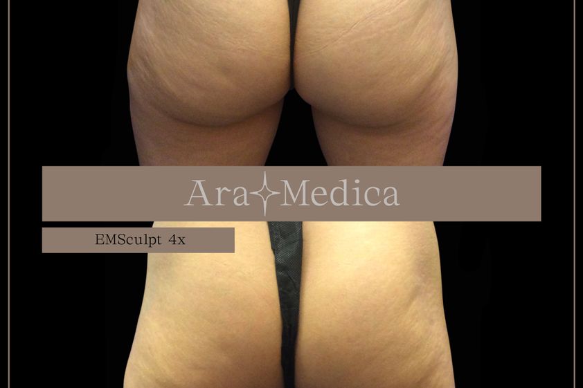 EMSculpt® prima e dopo - 857981